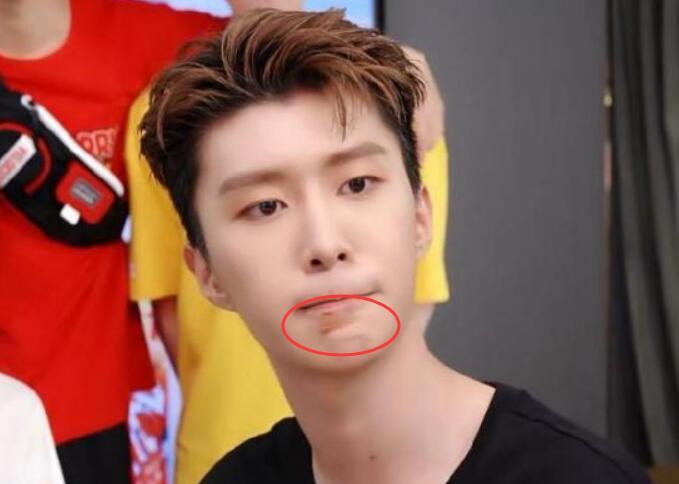 网曝范丞丞洗澡摔倒怎么回事范丞丞下巴伤痕明显会留疤吗