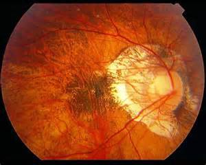 高度近视产生的眼底病变不可逆是怎么回事，关于高度近视产生的眼底病变不可逆吗的新消息。